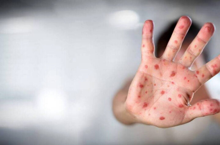 High-risk people can be vaccinated against monkeypox Vacunan contra viruela del mono a personas con alto riesgo