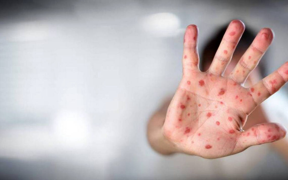 High-risk people can be vaccinated against monkeypox Vacunan contra viruela del mono a personas con alto riesgo