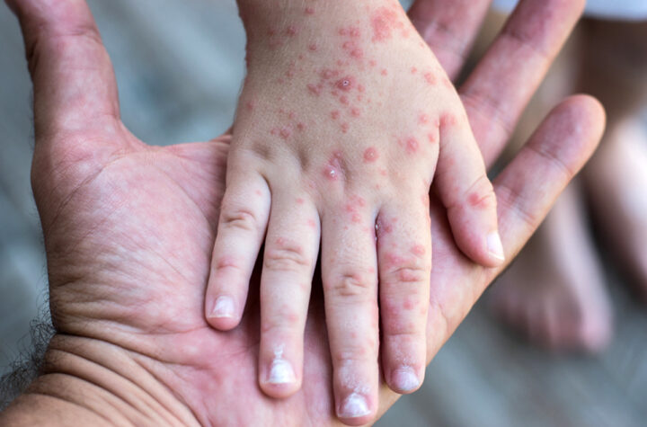 Brote de sarampión genera alarma sanitaria 