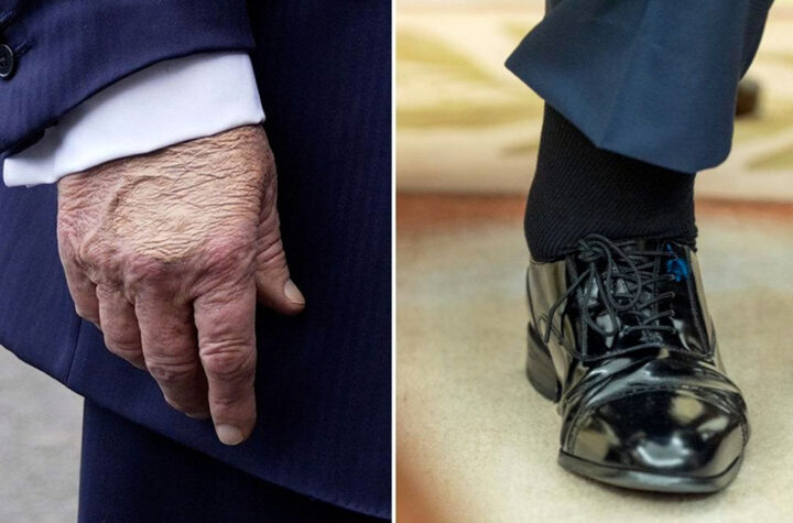 Trump pone en foco la insuficiencia venosa 