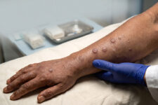 Aumentan los casos de Mpox en Denver